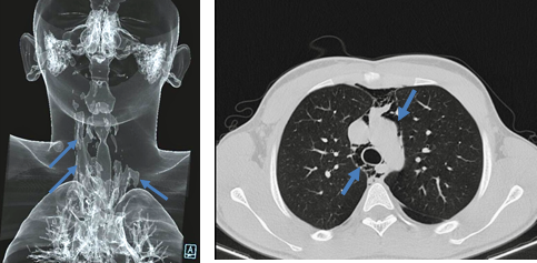 <b>Figure 2.</b> Patient chest computed tomography scan shows presence of interstitial air distributed bilaterally in the mediastinum, mainly on the right side and extending to the neck, and dissecting the anatomical planes of the upper mediastinum (arrows).